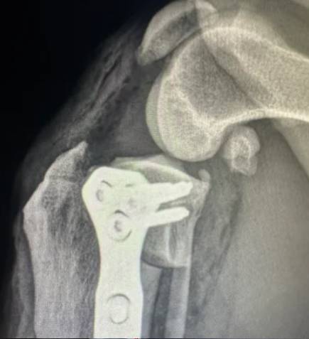 Post-Operative-Radiograph